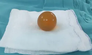 Viên hạt nở đồ chơi khiến bé 2 tuổi tắc ruột Viên hạt nở đồ chơi khiến bé 2 tuổi tắc ruột