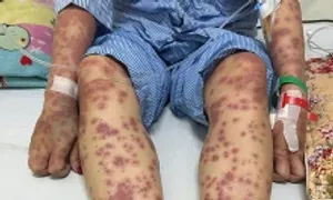Dị ứng nặng sau uống viên giảm cân thải độc Dị ứng nặng sau uống viên giảm cân thải độc